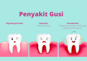 Cara Menjaga Kesehatan Gusi agar Terhindar dari Penyakit Mulut